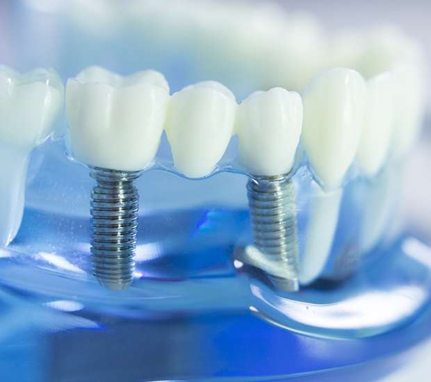 Encino Dental Implants