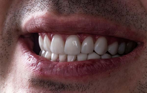 Full Mouth Reconstruction: Replacing Teeth With Dental Implants